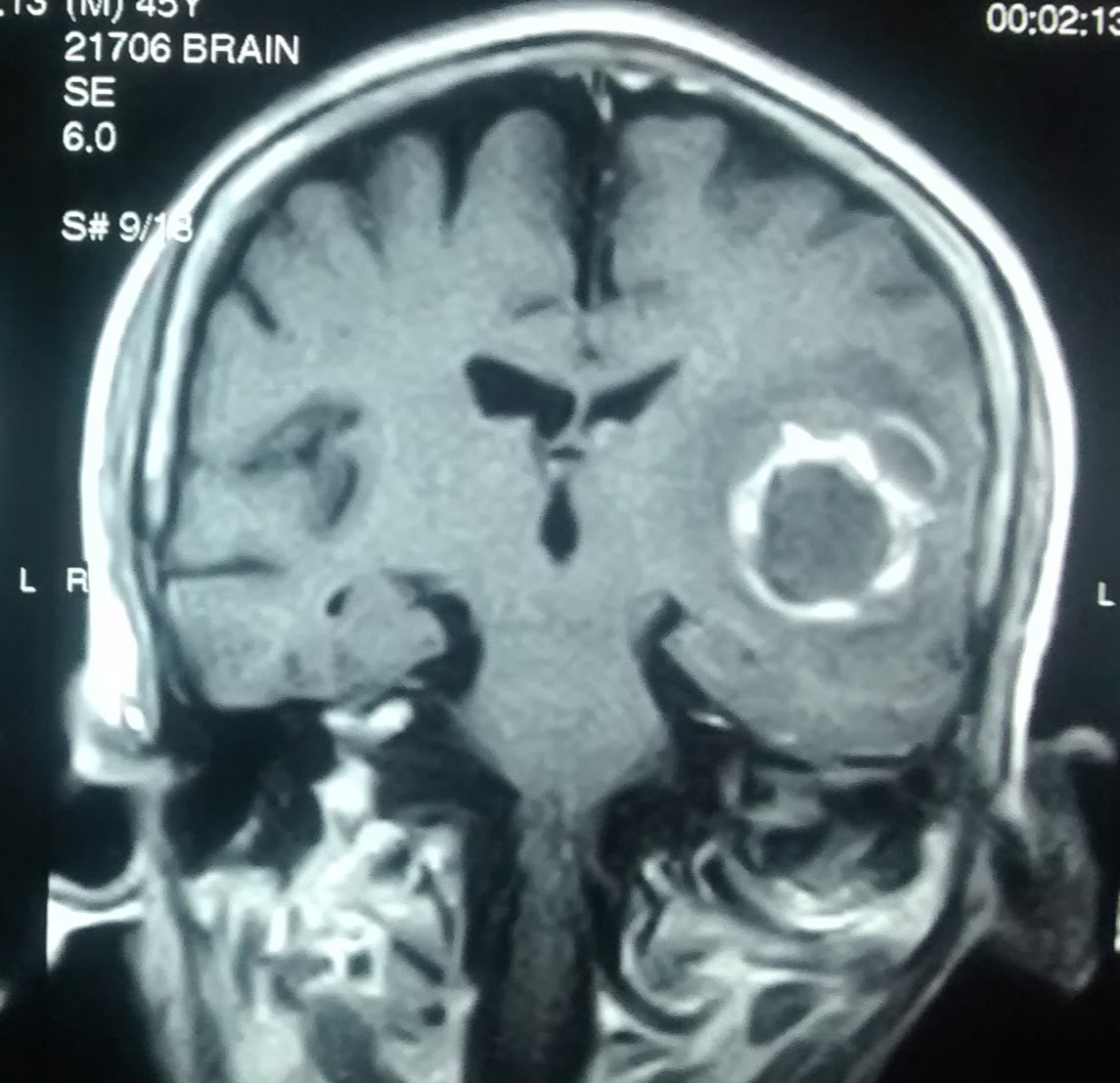 Brain Abscess
