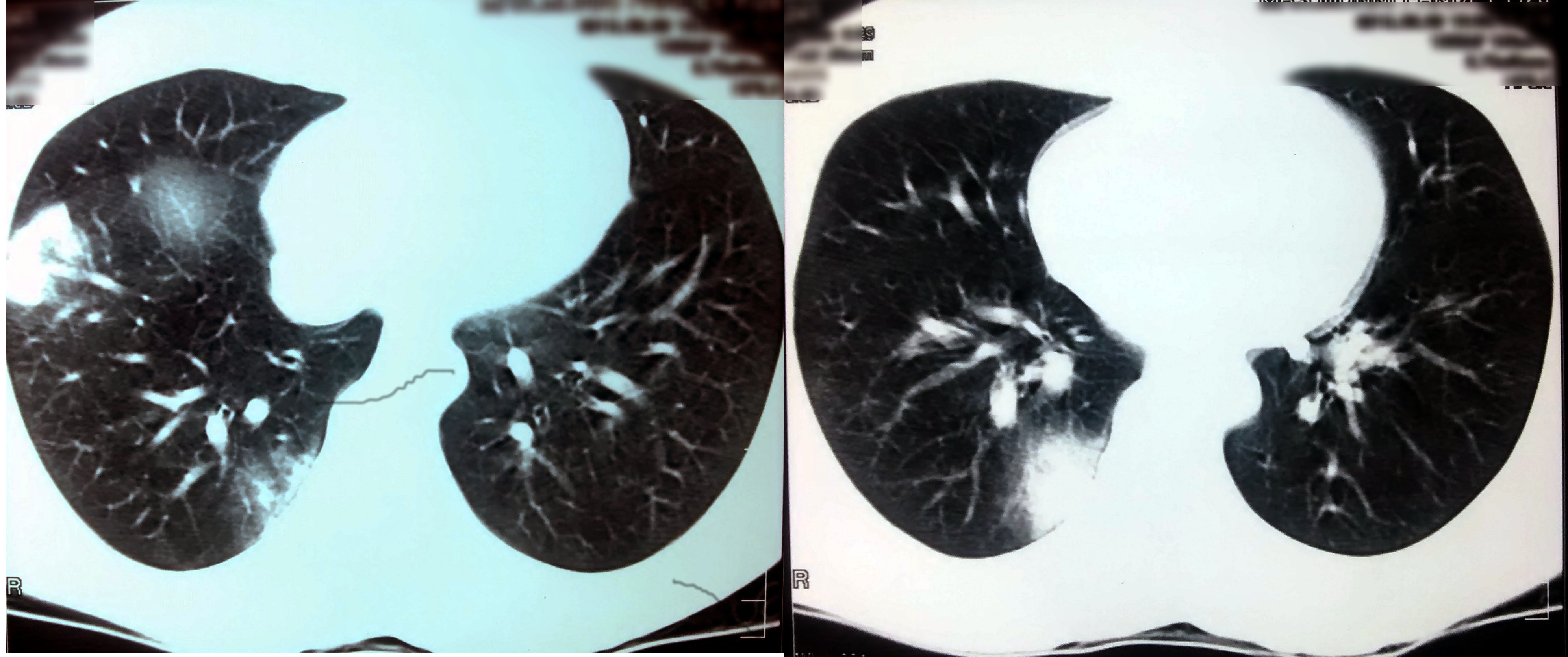 CT Chest Photograph