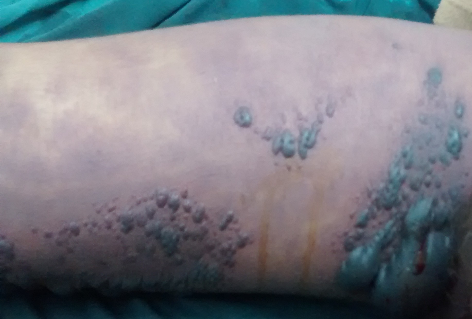 Gas Gangrene