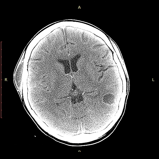 Brain abscesses