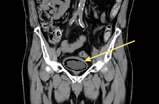 Emphysematous cystitis