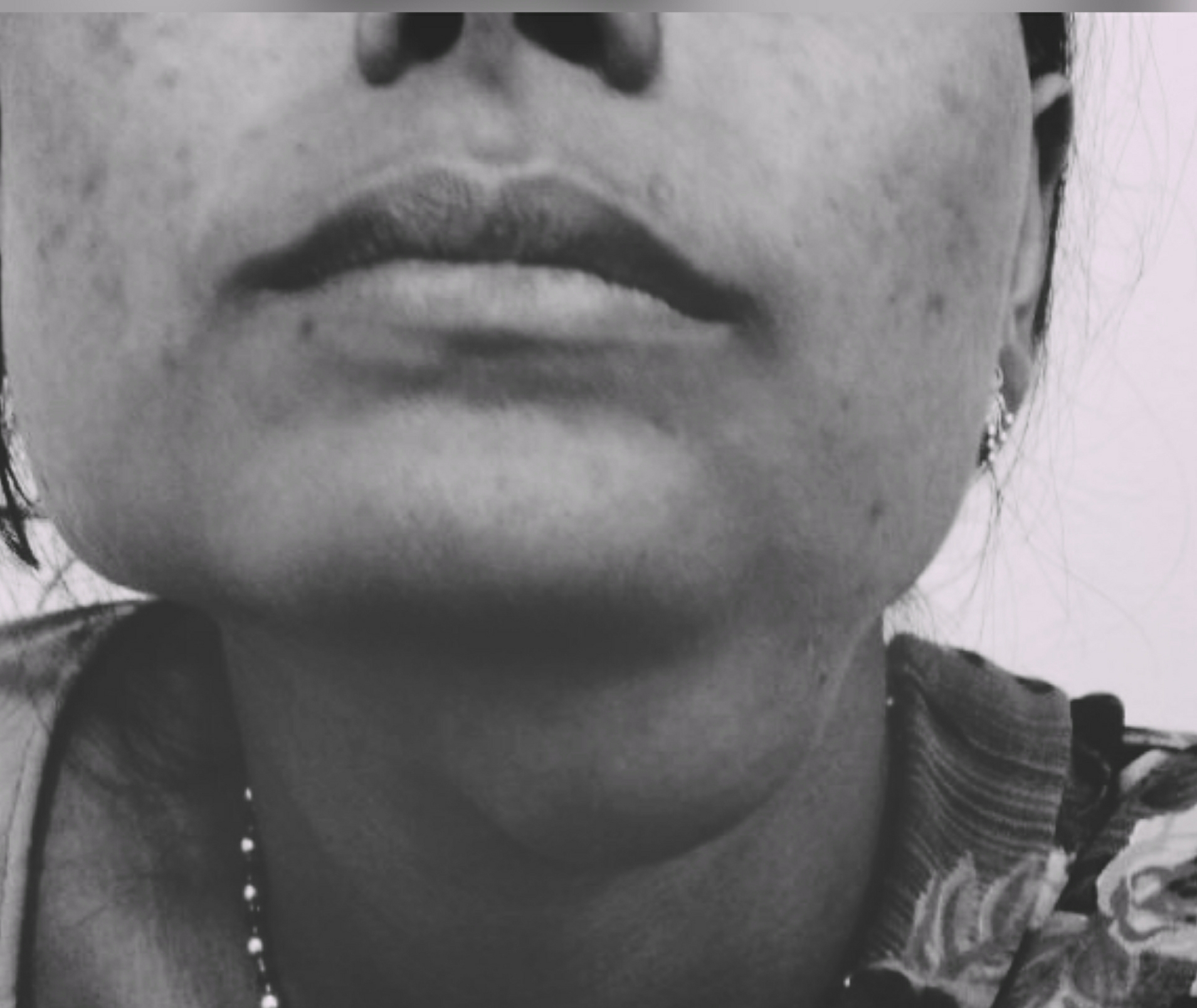 Submandibular abscess